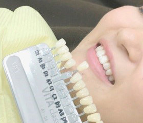 治療前の歯の色を確認