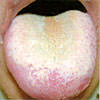 口臭の原因となり得る舌