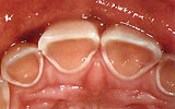 摂食障害をもつ方の上の歯の写真