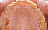 摂食障害をもつ方の上の歯の写真