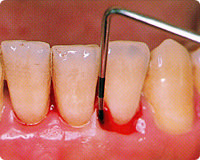 歯周検査の様子