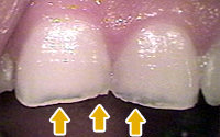内因性酸蝕症の歯の表側写真
