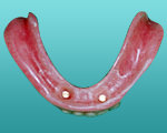 下の総義歯の裏面写真