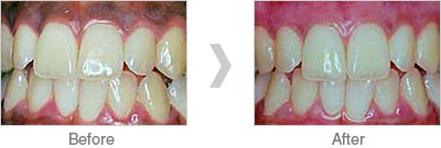 写真：歯肉メラニン除去の治療例