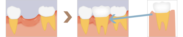 自家歯牙移植のイメージ図