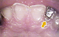 内因性酸蝕症の上顎前歯口蓋側写真